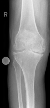 Kniegelenk Röntgenaufnahme