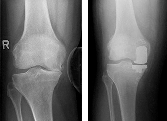 Röntgenaufnahme Kniegelenk mit Teilprothese
