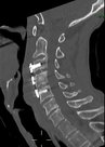 Seitliche Ansicht einer ventralen Stabilisierung der Halswirbelsäule bei diskoligamentärer (Typ-B) Verletzung