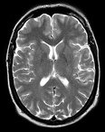 MRT-Schnitte durch das normale menschliche Gehirn