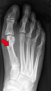 Röntgenbild Fuß mit Hallux Valgus nach OP