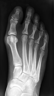 Röntgenbild Fuß mit Hallux Valgus