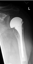 Röntgenbild der Schulter Frakturprothese