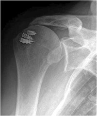 Röntgenbild Rotatorenmanschettenschaden