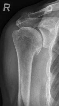 Röntgenbild Schultergelenk mit Arthrose