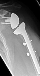 Röntgenbild der Schulter mit inverser Prothese nach Wechseloperation