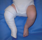 Abb.C: Säugling mit angelegtem Gips als konservative Therapiemöglichkeit bei einer Fußdeformation