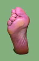 Ballenzehe mit Fußsohlenschmerzen